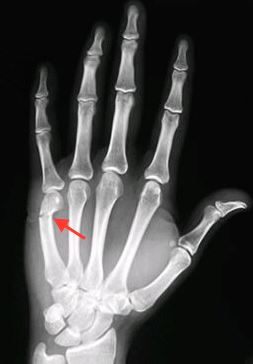 hand wrap prevents fracture