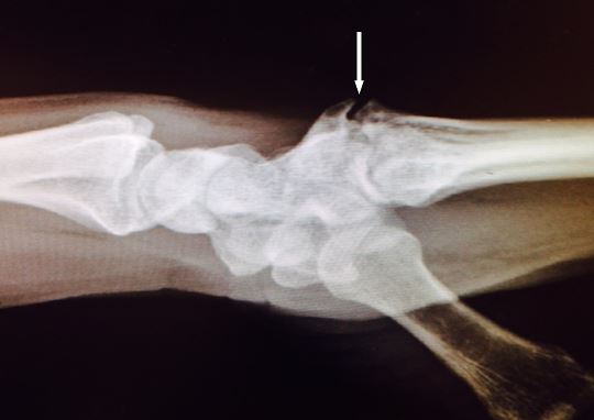 hand wrap prevent bossing