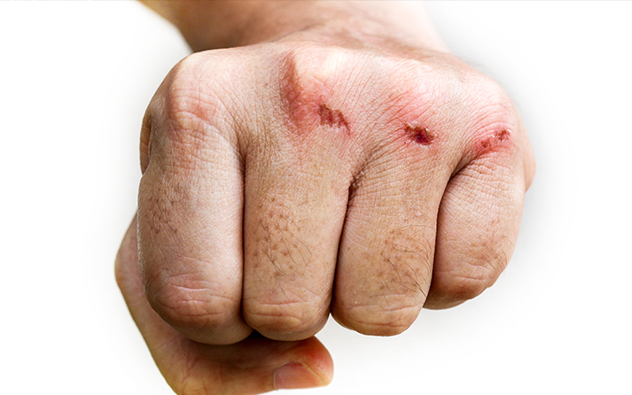 Injury Risks in Combat Sports 