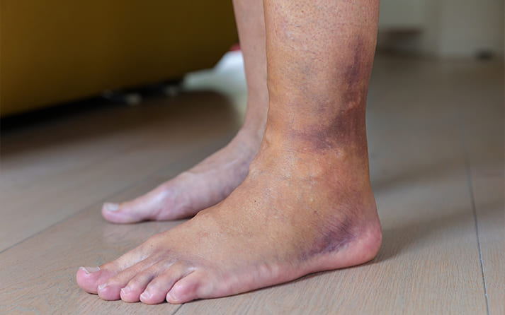 Bruising or Trauma