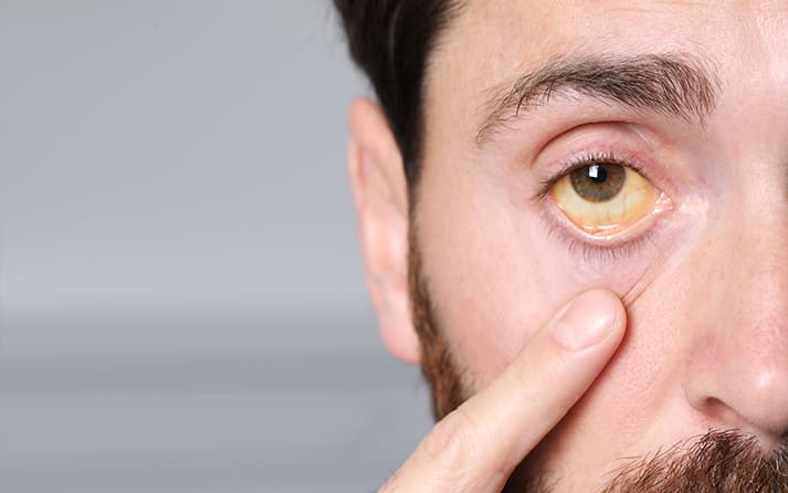 Jaundice or Liver Issues